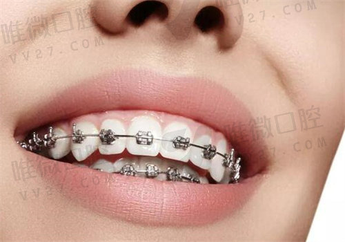 牙齿矫正的十大危害