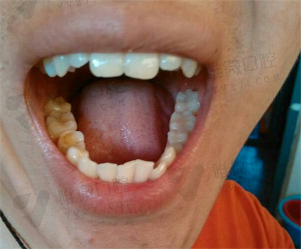 只有一颗牙齿歪了有必要整牙吗