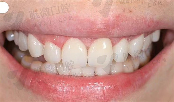 pola牙齿美白属于什么美白