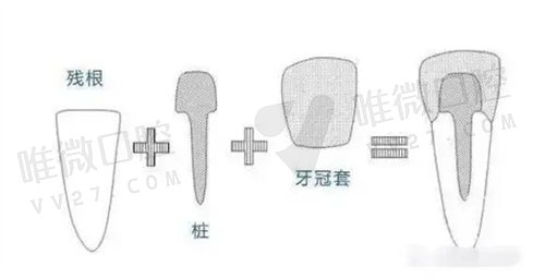 医生说牙太短了戴不了牙冠
