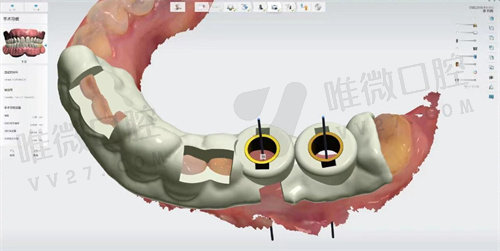 什么是3D导板种植牙技术