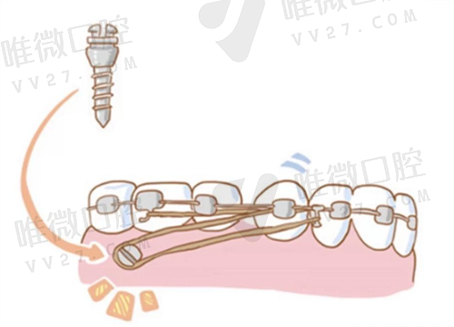 牙齿矫正支抗钉有什么用