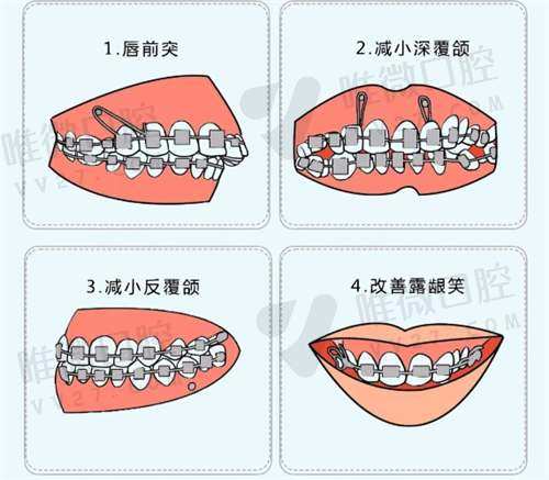 支抗钉一般戴多久才能摘下来