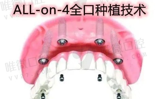 满口种植牙需要打几个桩呢