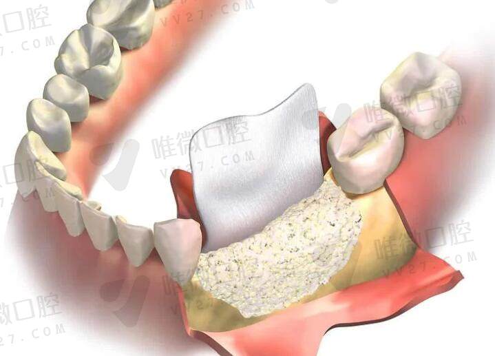 种牙打骨粉对身体有副作用吗