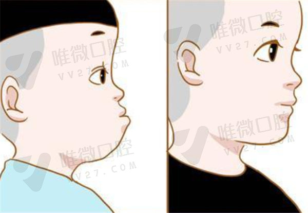 儿童反颌矫正器哪种比较好用