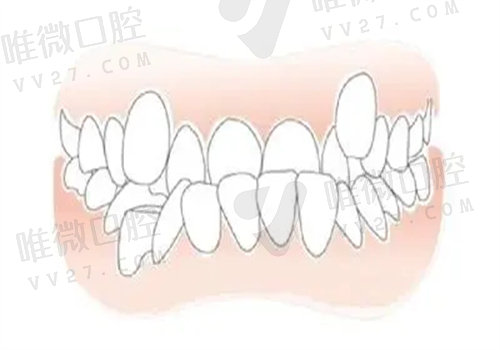 骨性反倾矫正手术一般费用多少