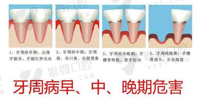 牙周炎是怎么样形成的？牙周炎的症状有哪些？