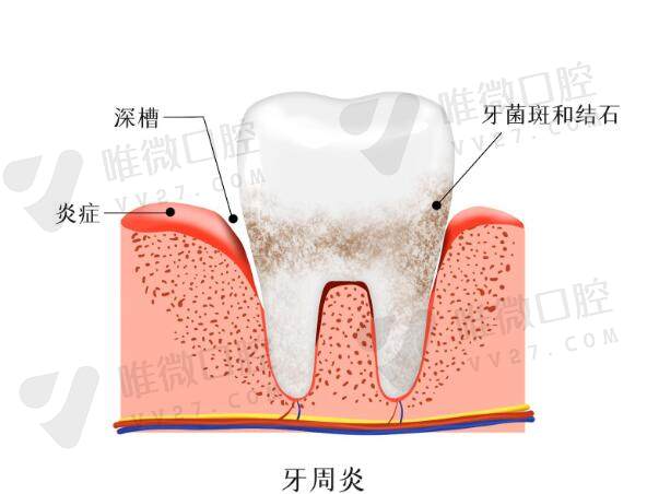 拔除或保留的优缺点比较