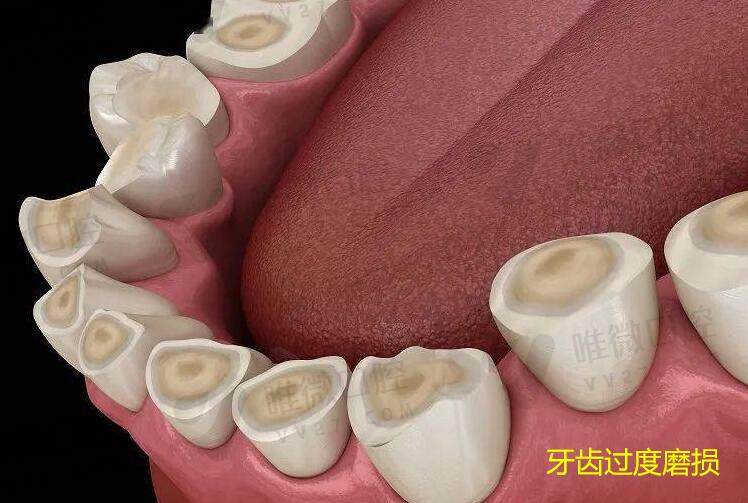 牙齿过度磨损的原因？