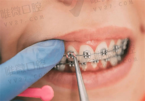 北京科尔口腔做的牙齿矫正好