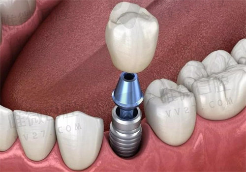 广州柏德口腔种植牙怎么样
