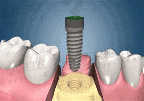 广州柏德口腔种植牙好不好