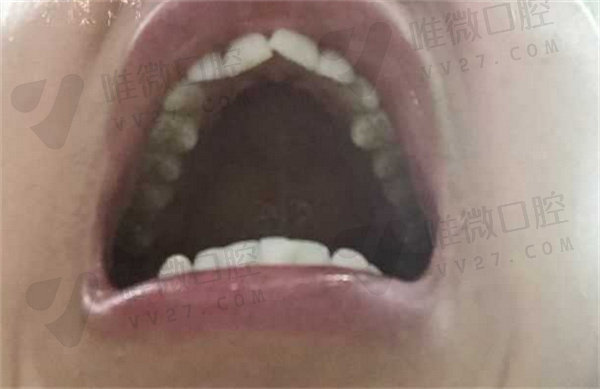 一颗龅牙能单独矫正一颗牙吗