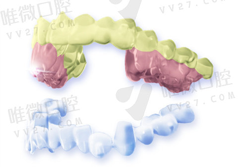 宁海牙贝恩口腔门诊部隐形矫正多少钱