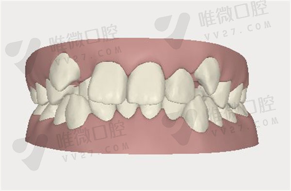 牙齿拥挤可以戴隐形牙套吗