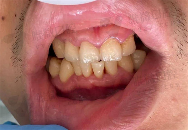 轻度牙周炎会导致牙齿松动吗
