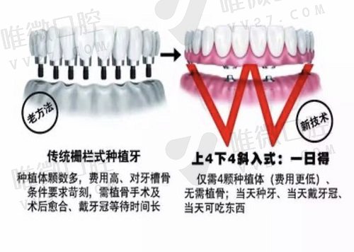穿颧穿翼种植牙是什么