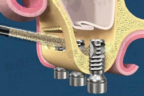 3D数字化动态导航种植牙过程