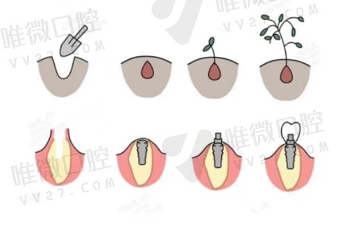 7D微创速导种植牙技术是什么