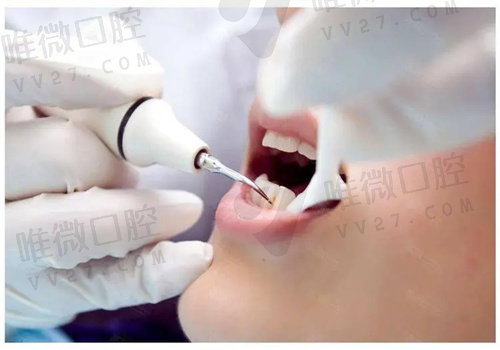 磁致伸缩洁牙原理是啥？磁致伸缩洁牙和超声波洁牙哪个好？
