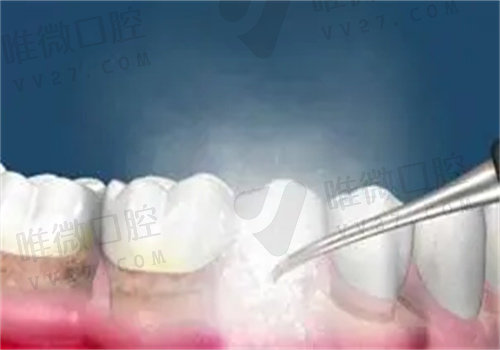 磁致伸缩洁牙原理是啥？磁致伸缩洁牙和超声波洁牙哪个好？