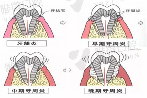 牙周刮治有必要做吗