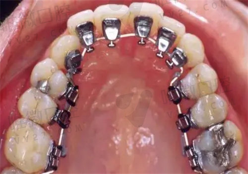 延安牙卫士口腔医院牙齿矫正多少钱