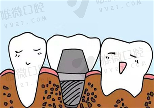 80岁老人能种牙不？还有必要进行种牙吗？会不会很危险吗？