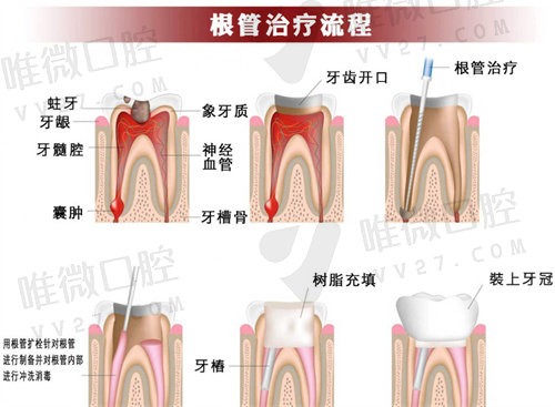 重庆儿童牙齿根管治疗费用多少