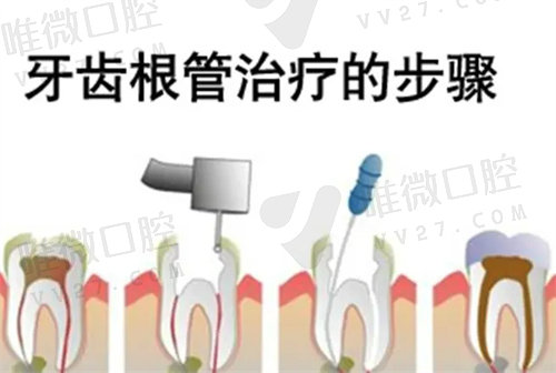 重庆牙齿根管治疗+安装牙冠费用多少