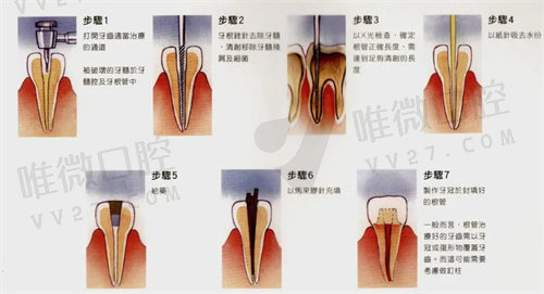 重庆牙齿根管治疗便宜又好的医院是哪些