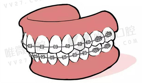 长沙牙齿矫正多少钱