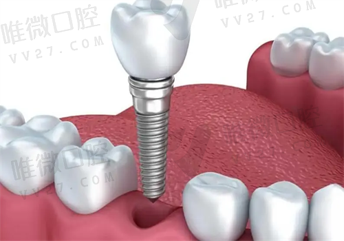 广州种植牙好的医院是哪家？