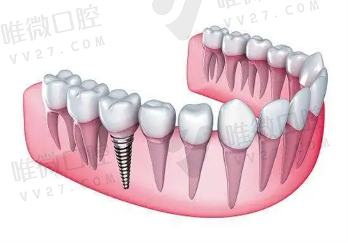 广州种植牙好的医院是哪家？