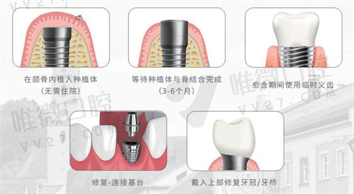 西安中诺口腔医院做韩国种植牙技术好不好