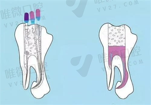 西安诺贝尔口腔医院根管治疗