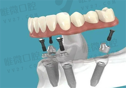 长春爱馨口腔种植牙怎么样