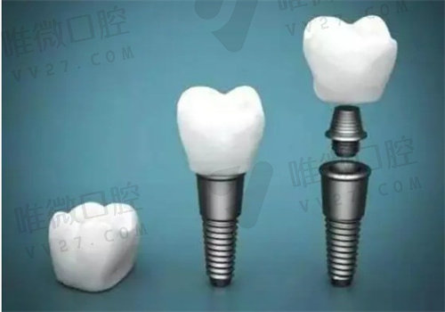 长春爱馨口腔种植牙怎么样