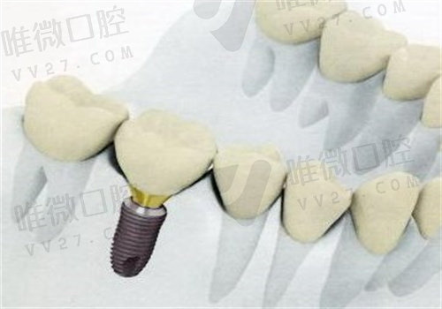 长春爱馨口腔种植牙价格表