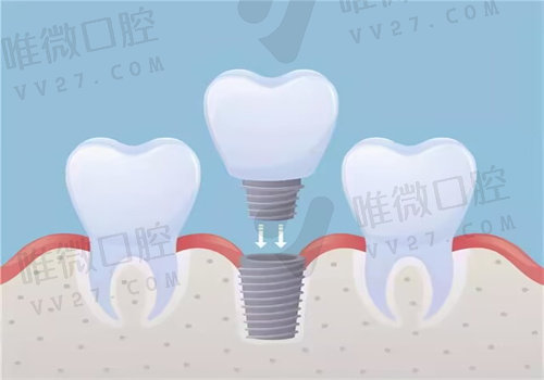 洛阳不同区域根管治疗收费标准明细