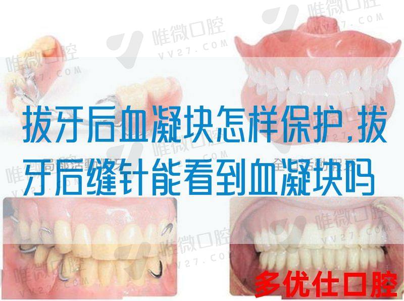 拔牙后血凝块怎样保护,拔牙后缝针能看到血凝块吗(图1)