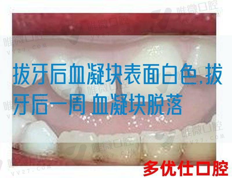 拔牙后血凝块表面白色,拔牙后一周 血凝块脱落(图1)