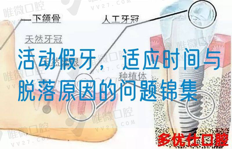 活动假牙，适应时间与脱落原因的问题锦集(图1)