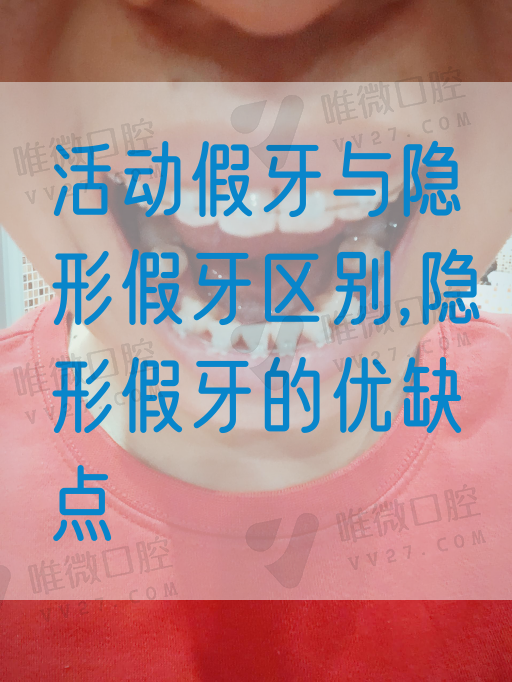 活动假牙与隐形假牙区别,隐形假牙的优缺点(图1)