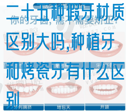 二十五种假牙材质区别大吗,种植牙和烤瓷牙有什么区别(图1)