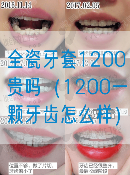 全瓷牙套1200贵吗（1200一颗牙齿怎么样）(图1)