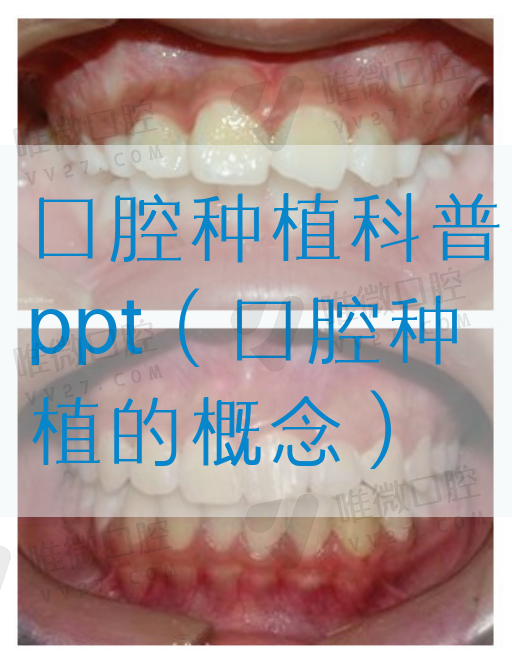 口腔种植科普*（口腔种植的概念）(图1)