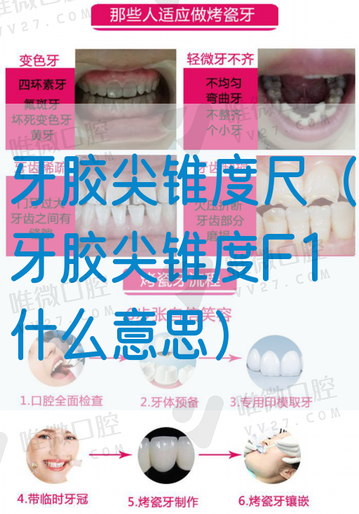 牙胶尖锥度尺（牙胶尖锥度F1什么意思）(图1)