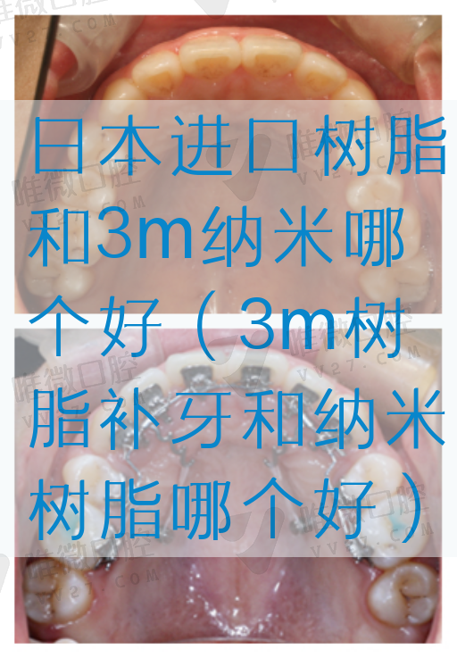 日本进口树脂和3m纳米哪个好（3m树脂补牙和纳米树脂哪个好）(图1)